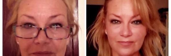 Világújdonság az arcliftingben